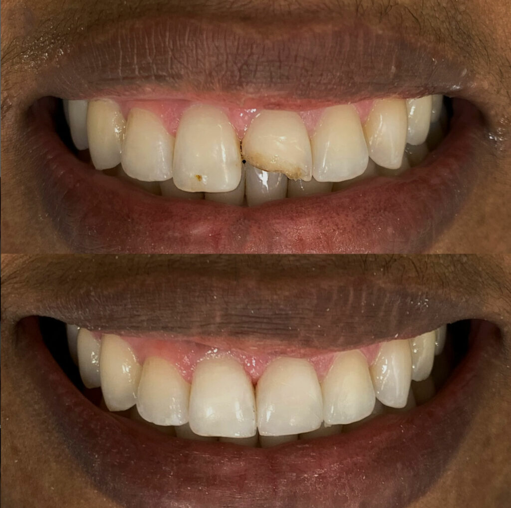 Prótese Protocolo Dentadura Fixa Implante Dentário
