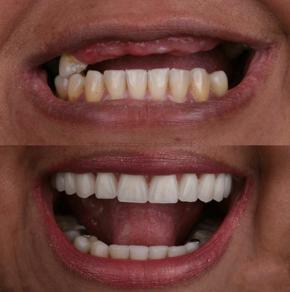 Prótese Protocolo Boca Toda Dentadura Fixa