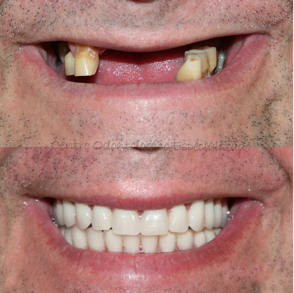 Prótese Protocolo Boca Toda Dentadura Fixa