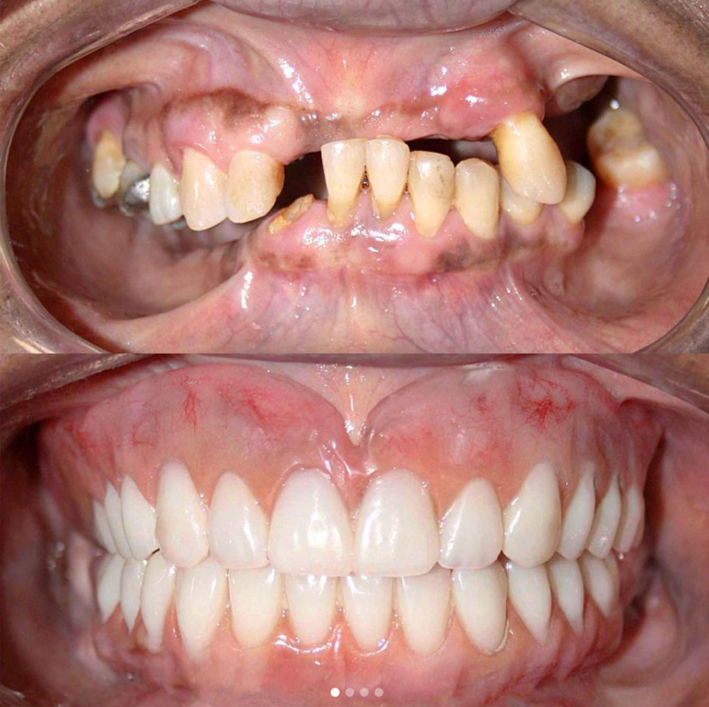 Prótese Protocolo Boca Toda Dentadura Fixa