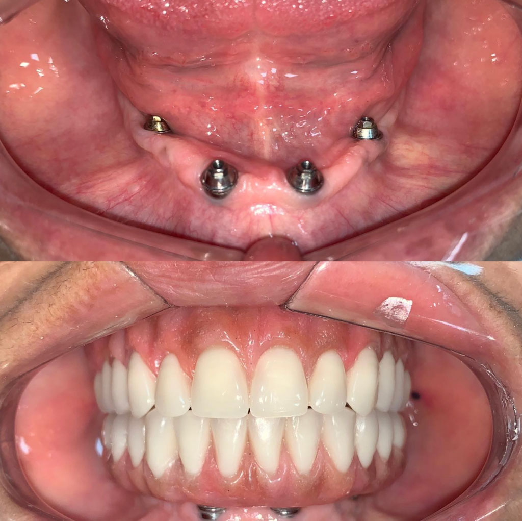 Prótese Protocolo Boca Toda Dentadura Fixa